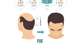 Hair Transplant Doctor in Indore