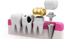 Dental Trends in Restorative Dentistry