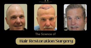 The-Science-of-Hair-Restoration-Surgery-Hair-Regrowth-Explained