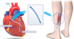 Tips to Getting Prepared for Heart Bypass Surgery