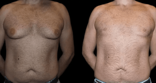 male breast reduction with before and after results