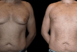 male breast reduction with before and after results