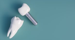 implant teeth price in Lahore