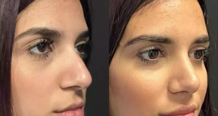 How to Address Nasal Bumps and Humps with Rhinoplasty