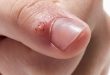 genital wart treatment