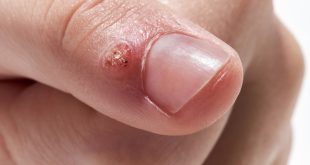 genital wart treatment