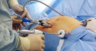 Best Hysteroscopic Surgeon in Dubai