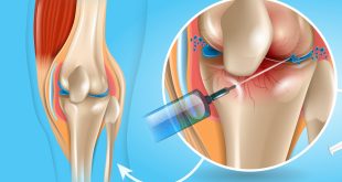 Osteoarthritis Therapeutics Market