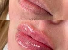 lip fillers in Dubai