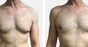 gynecomastia surgery in dubai abu dhabi sharjah