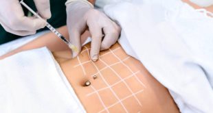 Liposuction surgery in Dubai