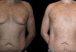 Male breast reduction with before and after results