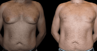 Male breast reduction with before and after results