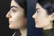 Choosing the Best Surgeon for Rhinoplasty in Dubai