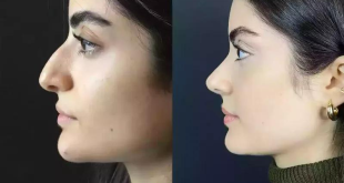 Choosing the Best Surgeon for Rhinoplasty in Dubai