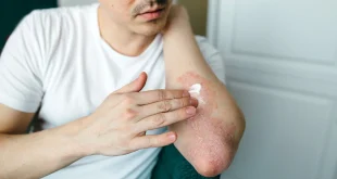 Plaque Psoriasis Drug