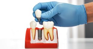 What Happens During a Dental Implant Procedure?