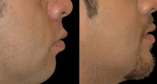 Double Chin Removal