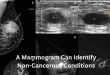 A Mammogram Can Identify Non-Cancerous Conditions