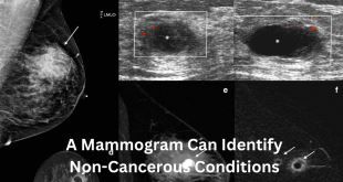 A Mammogram Can Identify Non-Cancerous Conditions