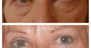 Eye Bag Removal