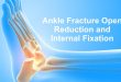 Ankle Fracture Open Reduction and Internal Fixation