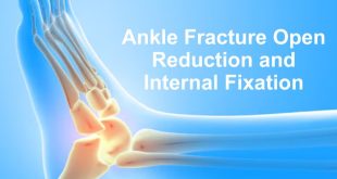 Ankle Fracture Open Reduction and Internal Fixation