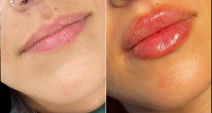 Juvederm