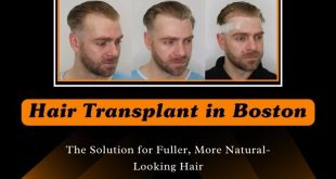 Hair-Transplant-in-Boston-The-Solution-for-Fuller-More-Natural-Looking-Hair