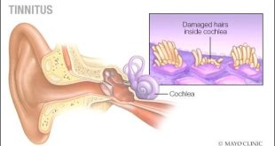 Tinnitus Cure in Pakistan & ASSR Hearing Test Price